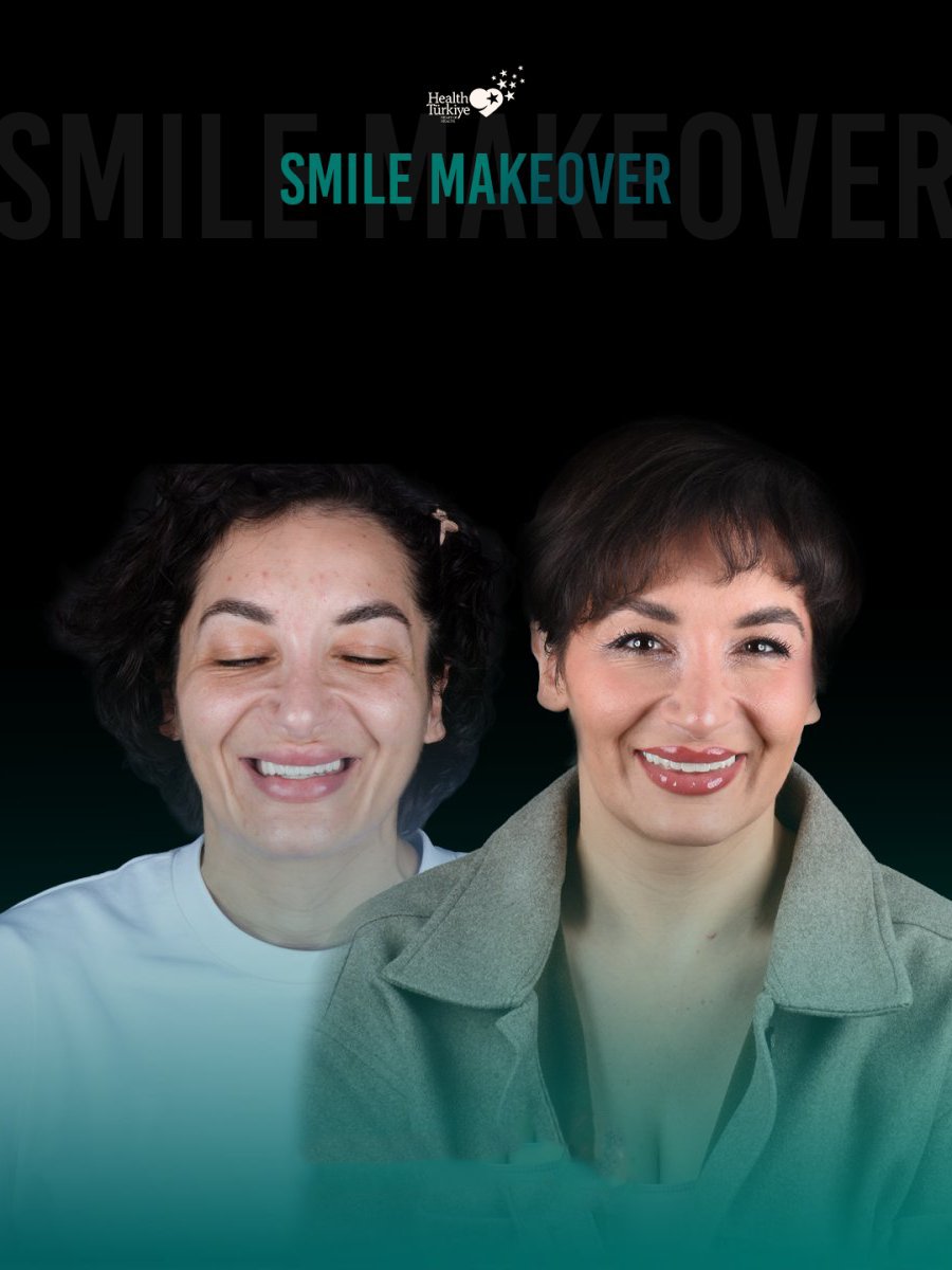 Resultados de sonrisa antes y después en Soraca Med – transformación dental visible