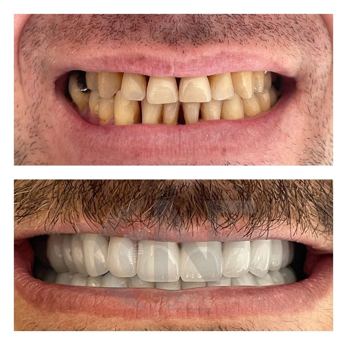 Before and after zirconia veneers at Nifa Dent International, smile makeover results