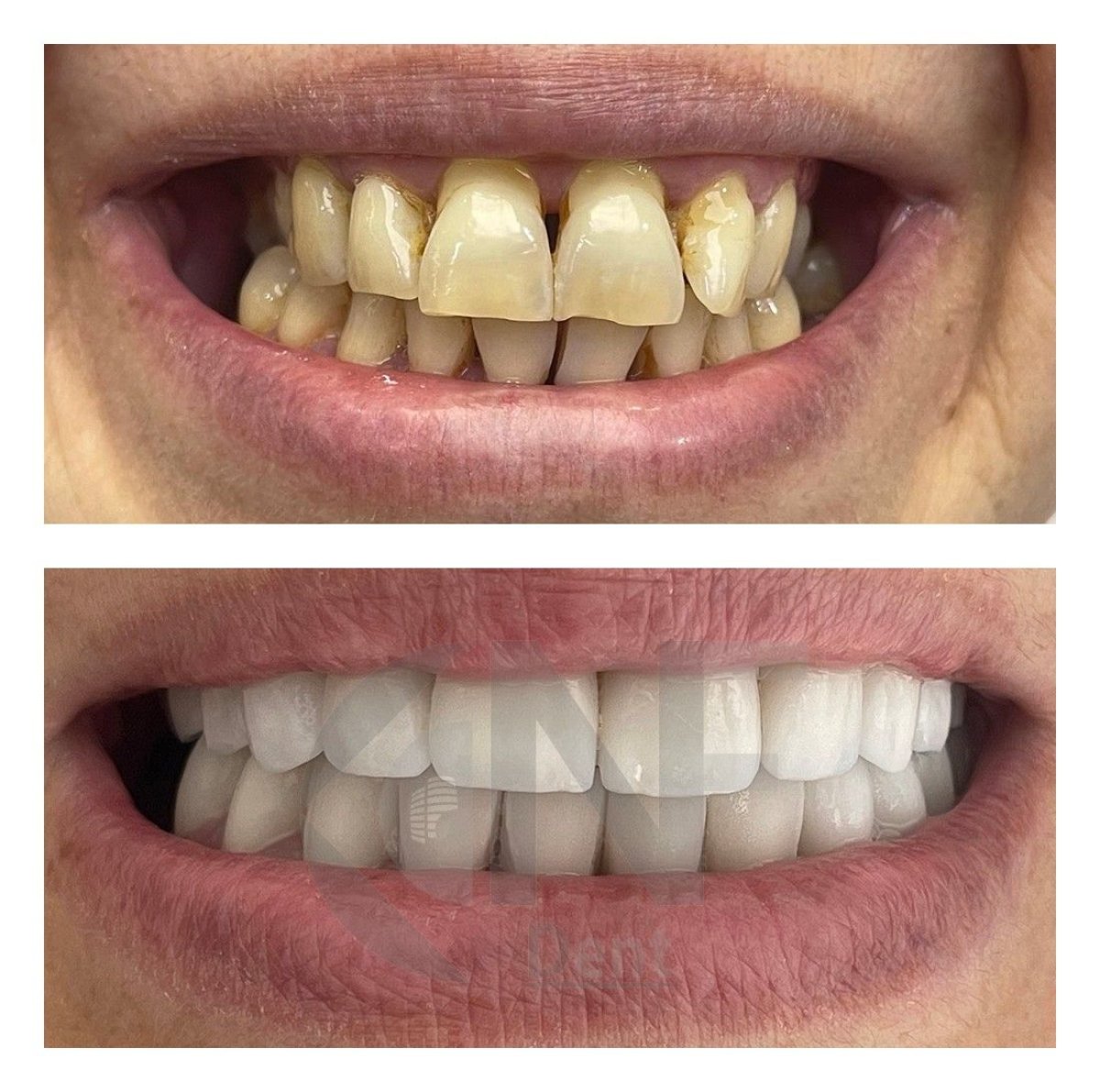 Before and after zirconia veneers results at Nifa Dent International – smile makeover