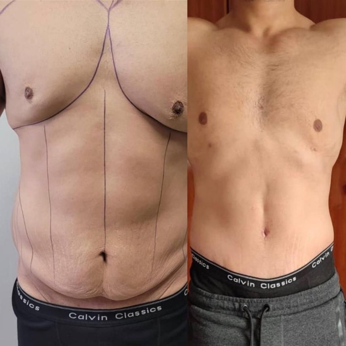 Efekty przed i po liposukcji Vaser w Dr. Safa Manav Clinic, poprawa konturu brzucha