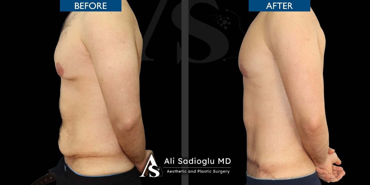 Resultados antes y después de Vaser lipo en Dr. Safa Manav Clinic, contorno abdominal mejorado