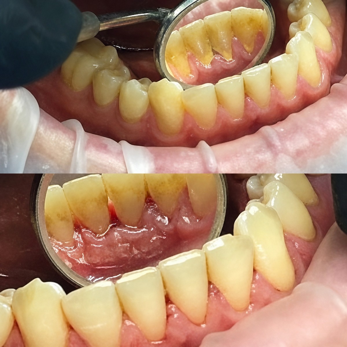 Before and after deep cleaning (scaling and root planing) result at Casa Dental, s.r.o.
