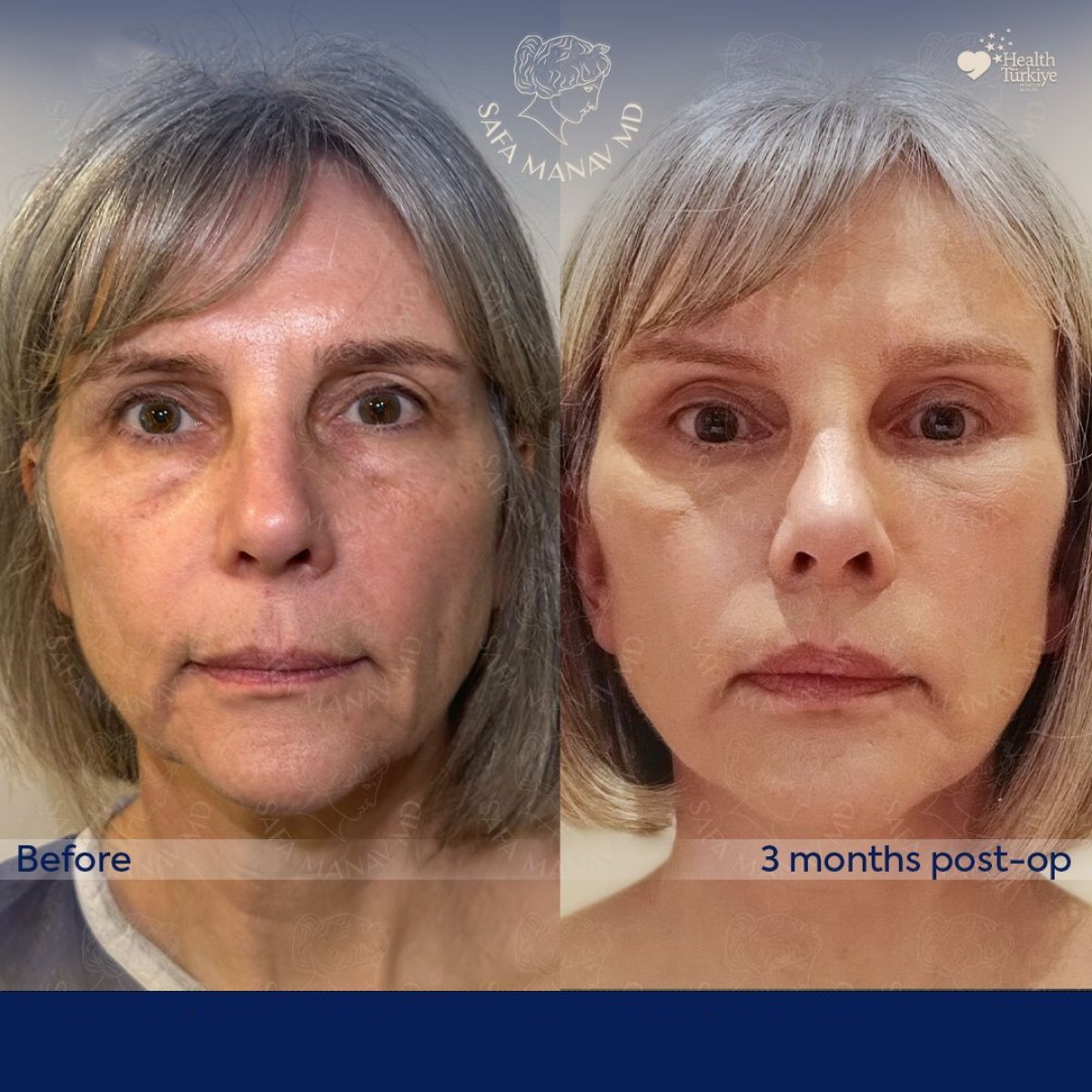 Facelift before and after results at Dr. Safa Manav Clinic, visible facial rejuvenation