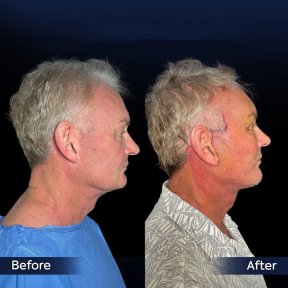 Facial Rejuvenation Package — 9 Nights at 4★ Medical Hotel & VIP Transfer - photo 6