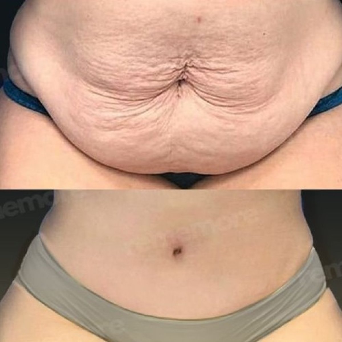 Before and after tummy tuck results at Memorial Ankara Hospital – improved abdominal contour