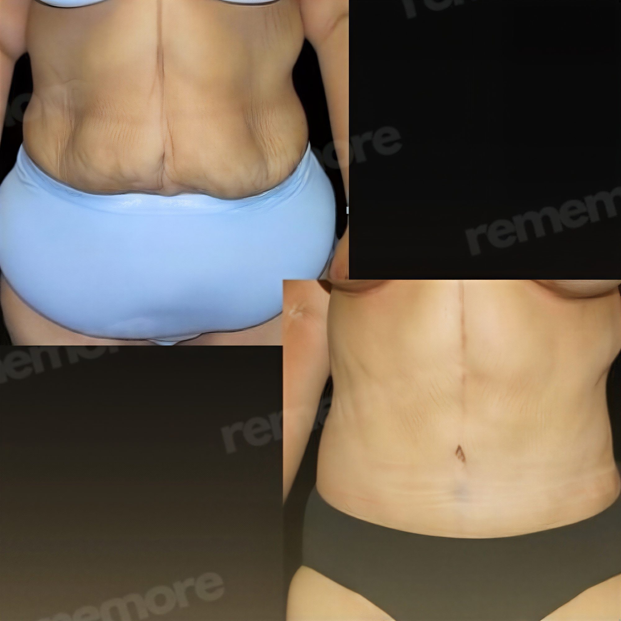 Resultados antes y después de abdominoplastia Fleur De Lis en Memorial Bahçelievler Hospital, contorno abdominal