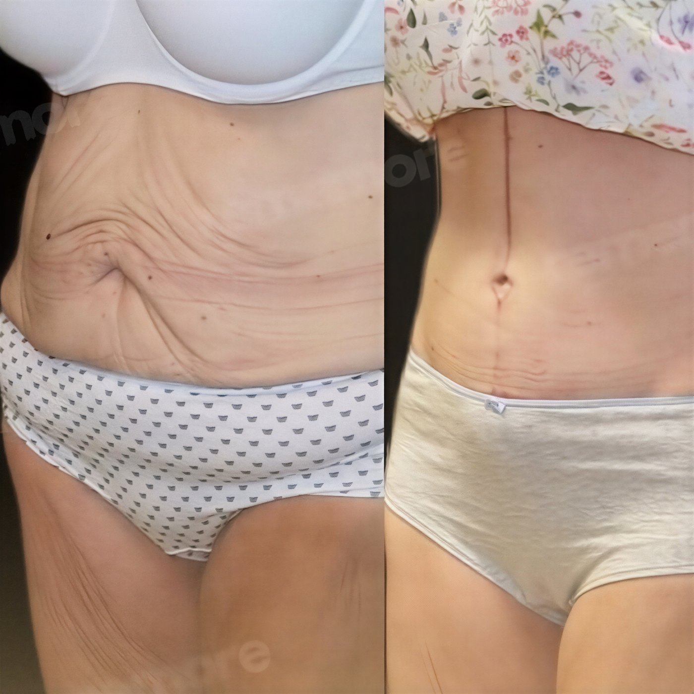 Resultados antes y después de abdominoplastia Fleur De Lis en Memorial Bahçelievler Hospital, abdomen