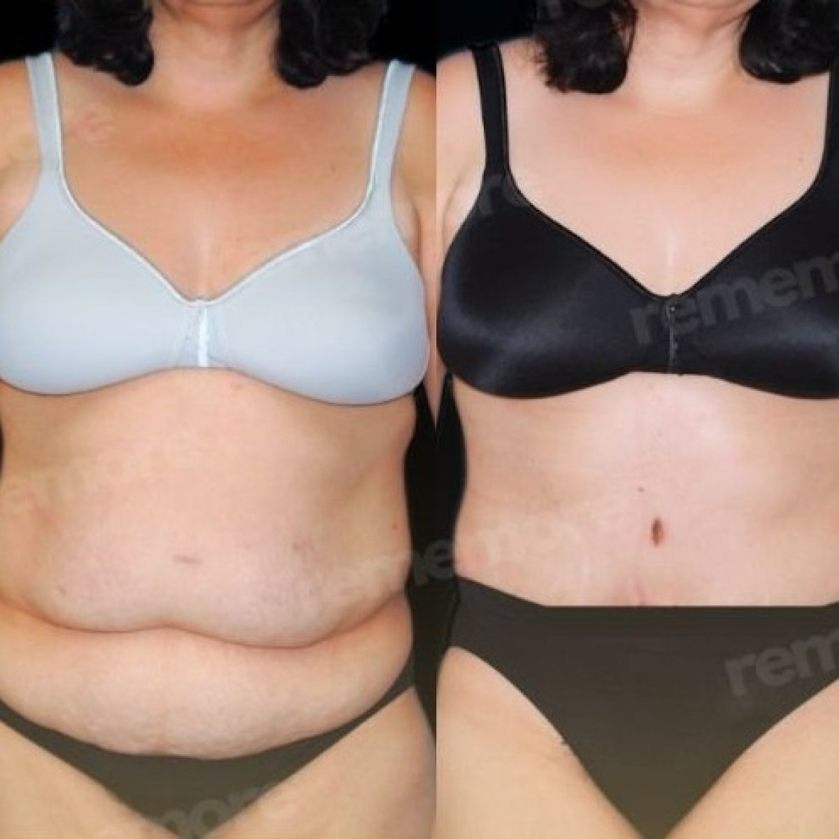 Before and after Fleur De Lis tummy tuck results at Memorial Bahçelievler Hospital, abdomen contour
