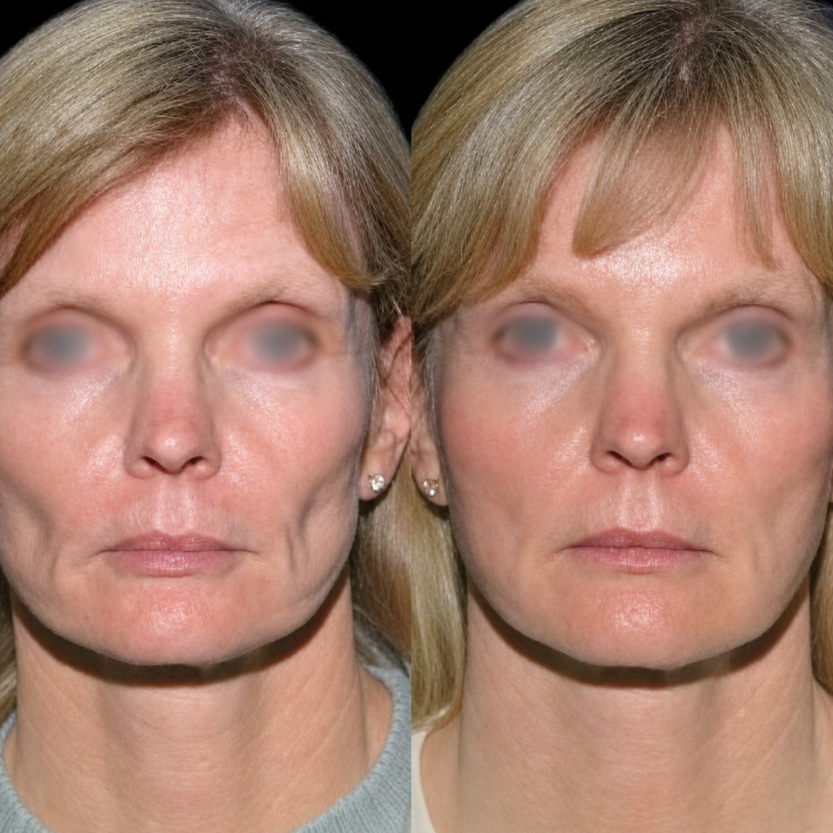 Before and after facial fat transfer results at Memorial Şişli Hospital, improved facial volume