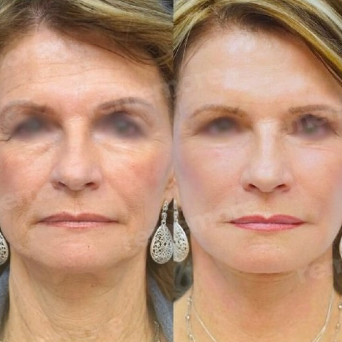 Before and after facial fat transfer results at Memorial Şişli Hospital, rejuvenated appearance