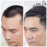 صور قبل وبعد زراعة الشعر للدكتور 