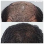 Before and after Hair transplant photos by Dr. 