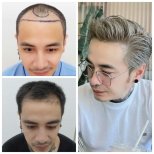 صور قبل وبعد زراعة الشعر للدكتور 