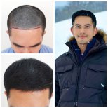 صور قبل وبعد زراعة الشعر للدكتور 