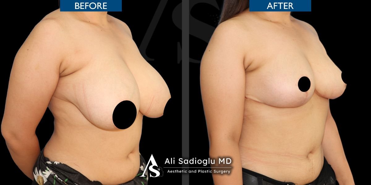 Resultados antes y después de reducción de senos en Dr. Safa Manav Clinic, mejor contorno