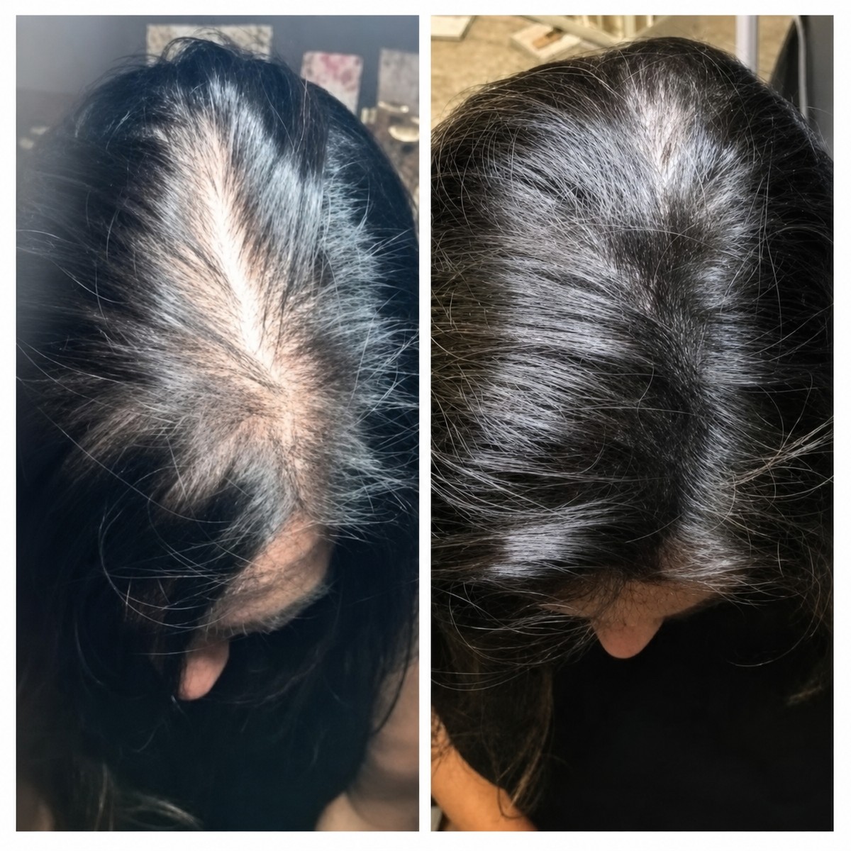 Résultats avant/après greffe de cheveux à CE International Hospital, densité améliorée