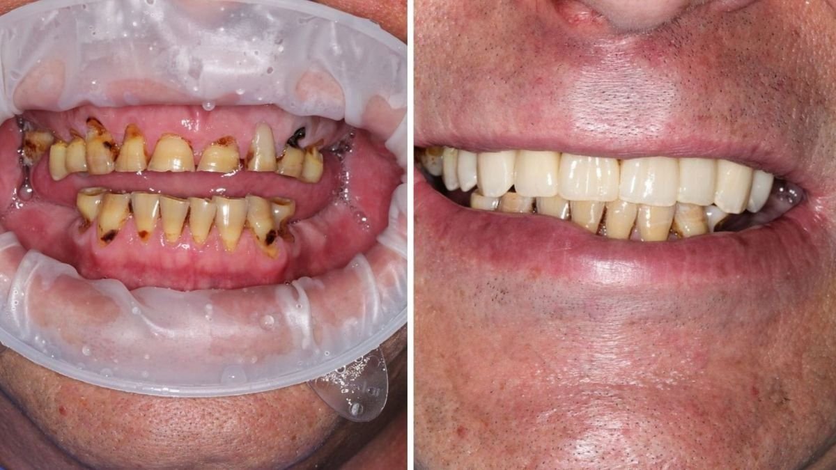 نتيجة قبل وبعد زراعة الأسنان All-on-6 في Smile Centrum – استعادة الابتسامة