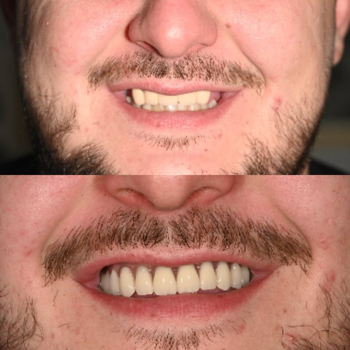 Résultats avant/après implants All-on-6 en un jour à Unident Clinic, sourire amélioré