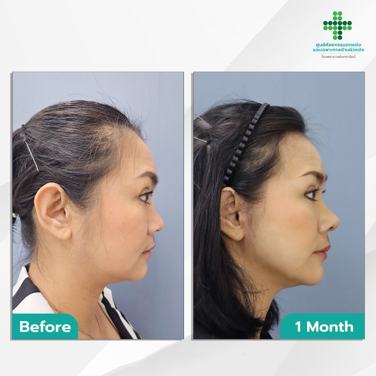 Resultados antes y después de Deep Plane Facelift en Intrarat Hospital – lifting facial visible