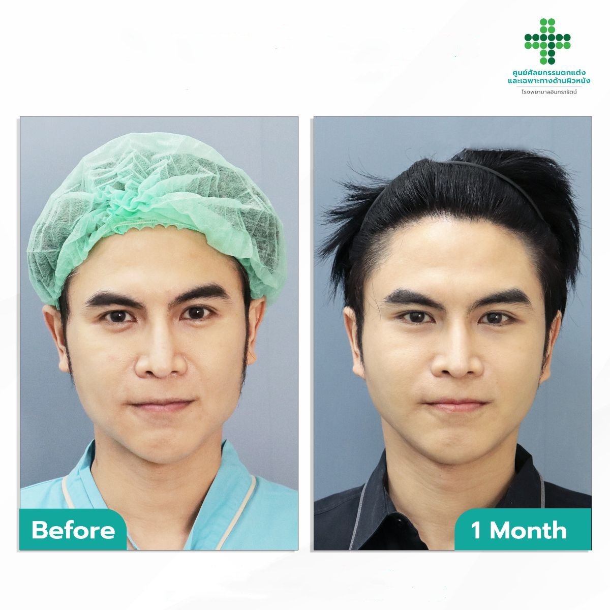 Resultados antes y después de deep plane facelift en Intrarat Hospital, rejuvenecimiento facial visible