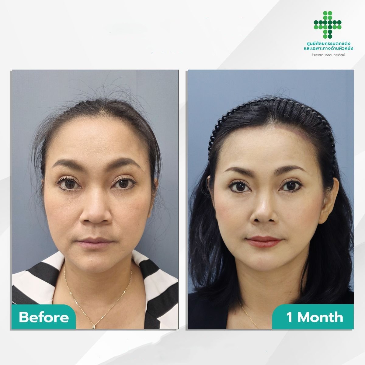 Before and after Deep Plane Facelift results at Intrarat Hospital, visible facial rejuvenation