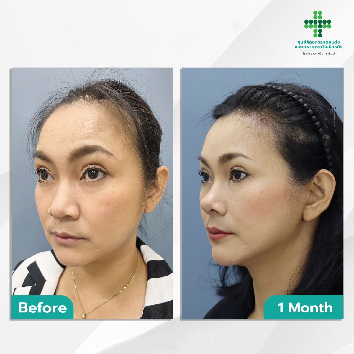 Resultados antes y después de Deep Plane Facelift en Intrarat Hospital, rejuvenecimiento facial visible