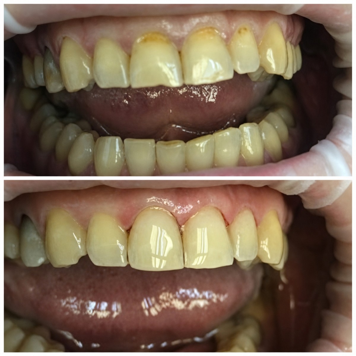 Before and after tooth restoration (bonding) result at Casa Dental, s.r.o. – improved smile