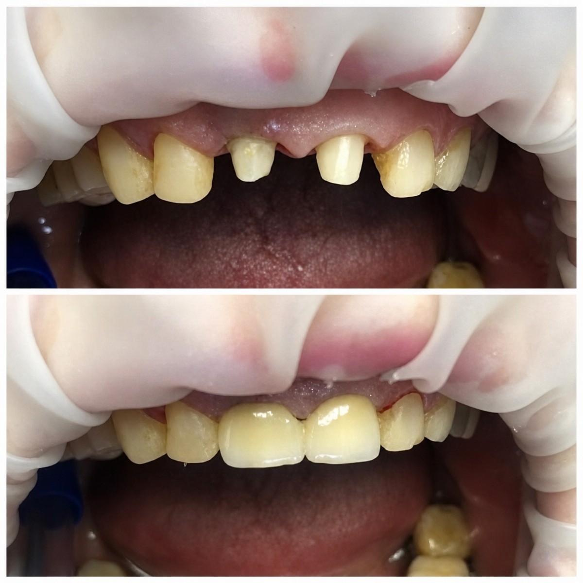 До и после установки зубных коронок в Casa Dental, s.r.o. – восстановление передних зубов