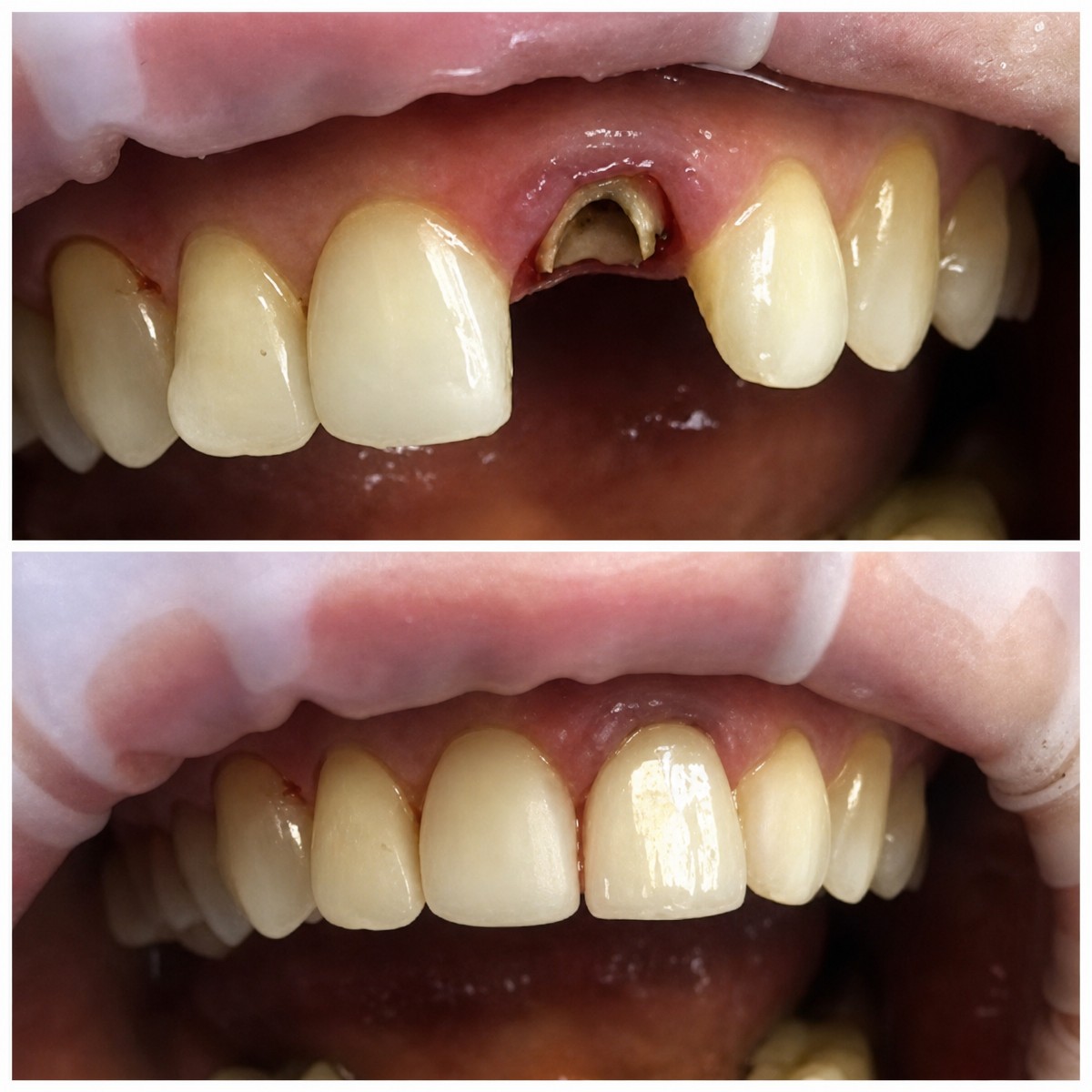 نتيجة قبل وبعد تركيب تاج الأسنان في Casa Dental, s.r.o. لإصلاح الأسنان الأمامية
