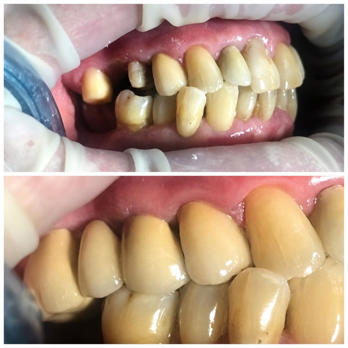 قبل وبعد تركيب تيجان الأسنان في Casa Dental, s.r.o.، نتيجة ابتسامة محسنة