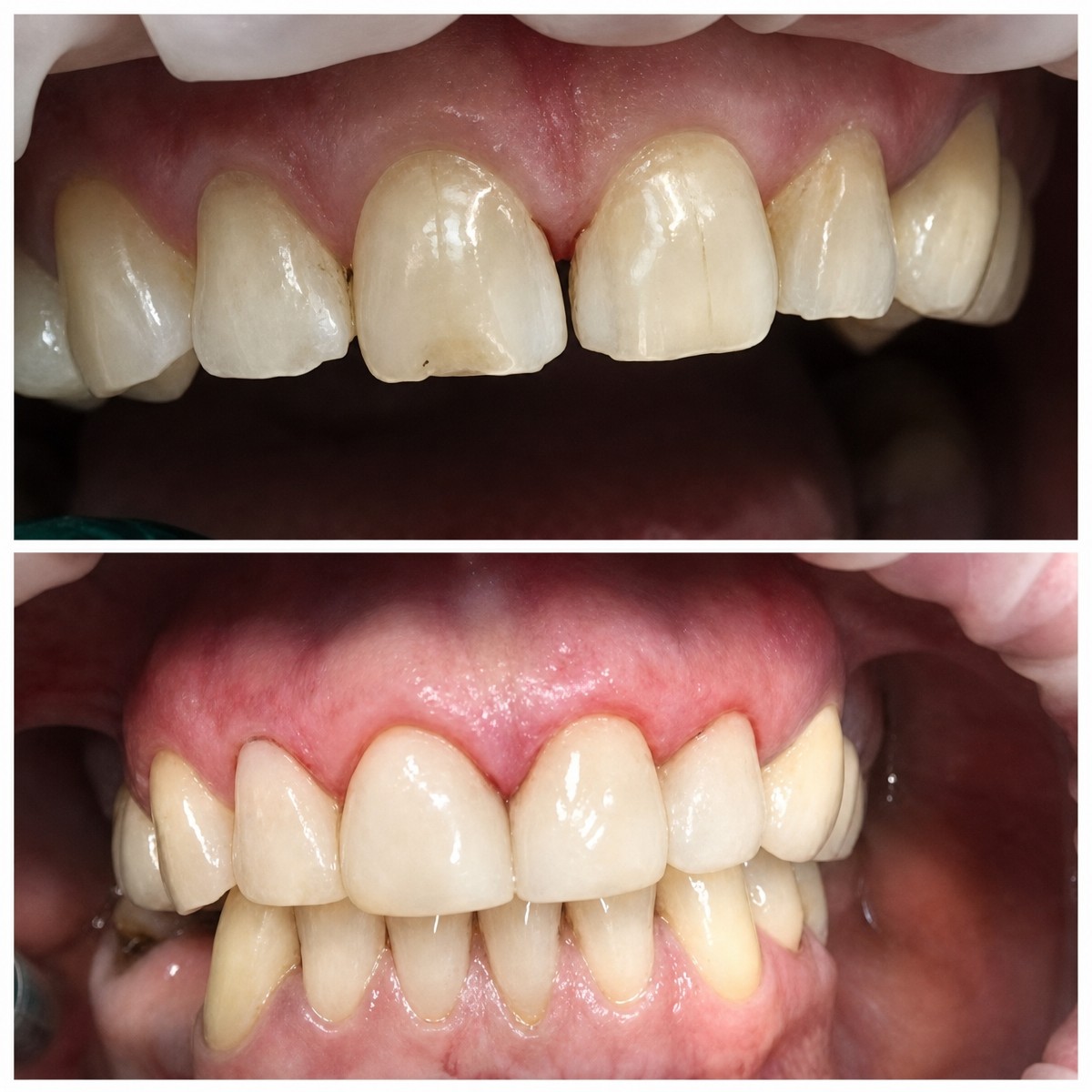 Resultados antes y después de carillas de porcelana en Casa Dental, s.r.o. – sonrisa mejorada
