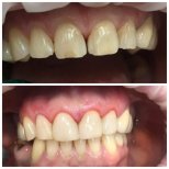 Before and after Composite Veneer photos by Dr. 