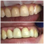 Before and after Composite Veneer photos by Dr. 