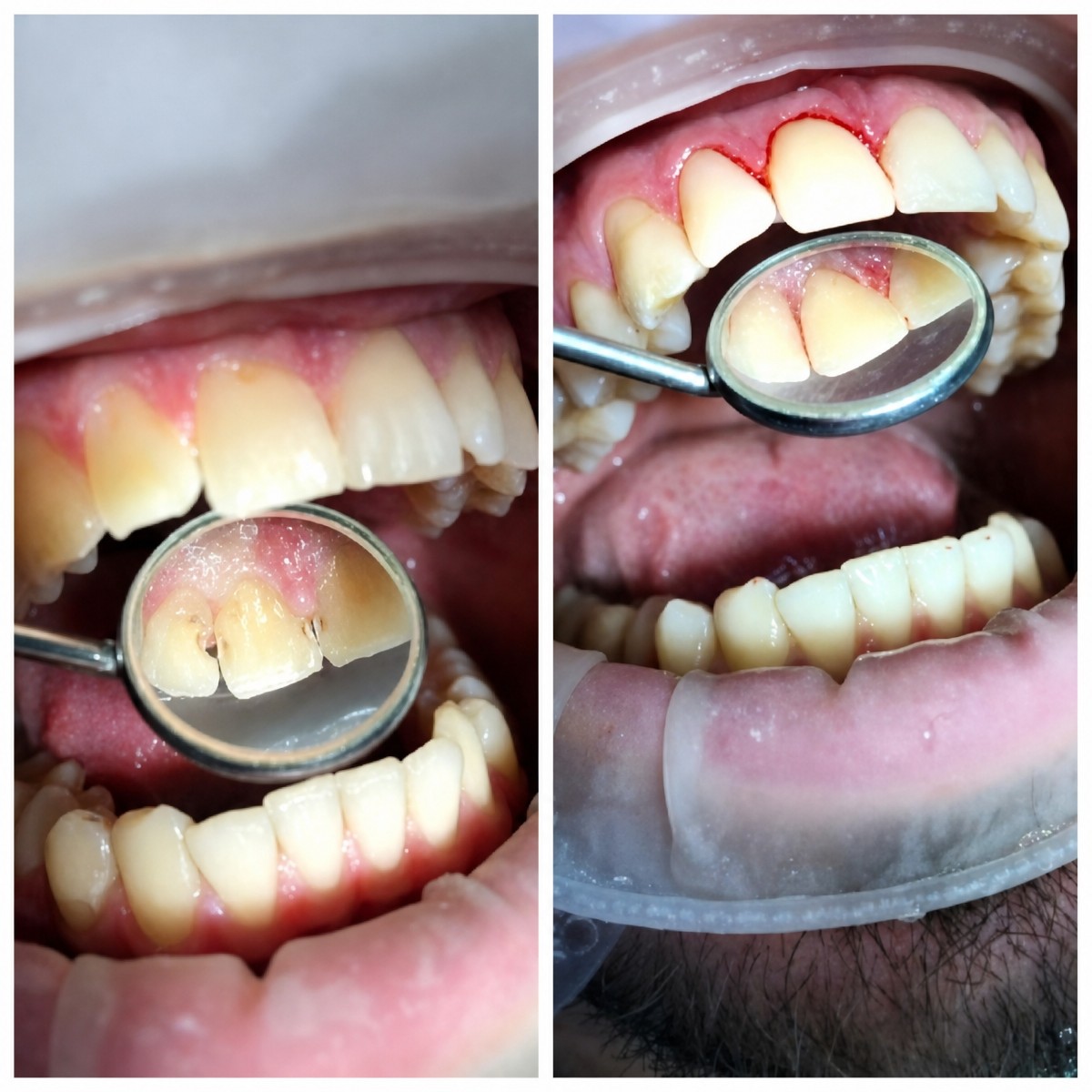 Before and after deep cleaning (scaling and root planing) result at Casa Dental, s.r.o.