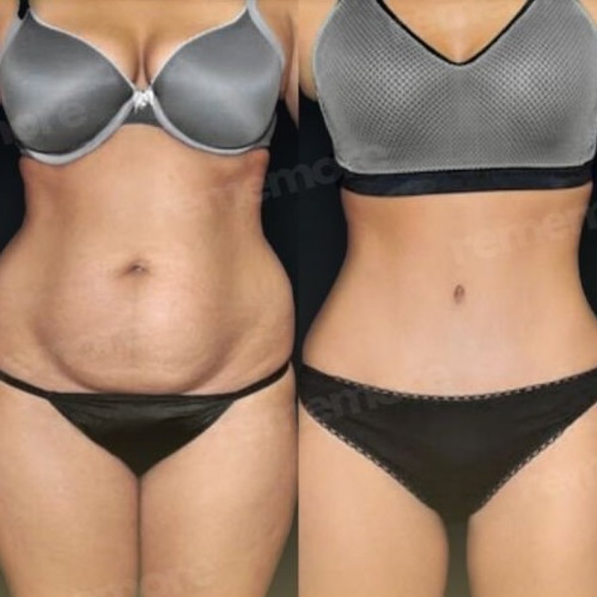 Resultados antes y después de lifting corporal completo en Memorial Göztepe Hospital, mejor contorno