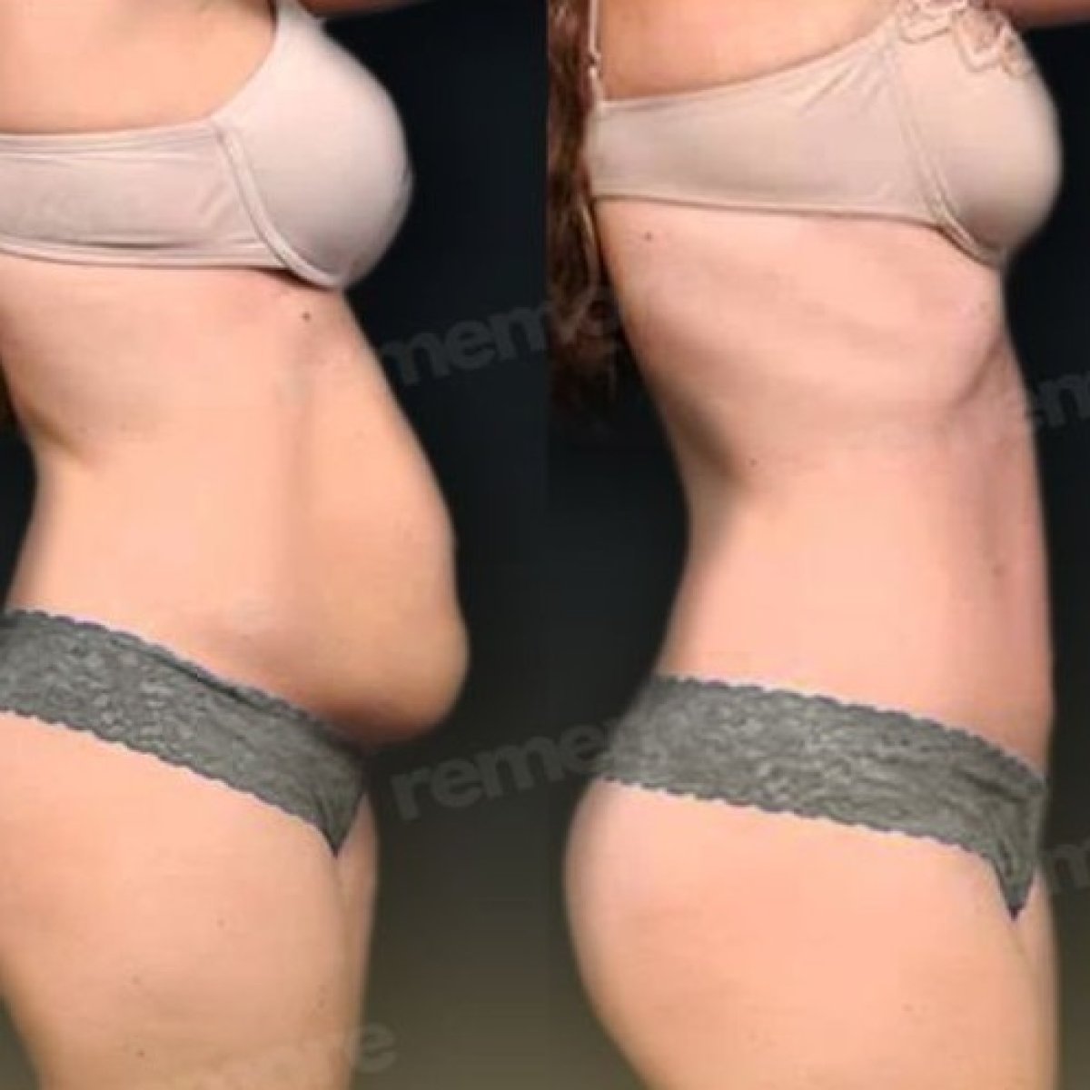 Resultados antes y después de lifting corporal completo en Memorial Göztepe Hospital, mejor contorno