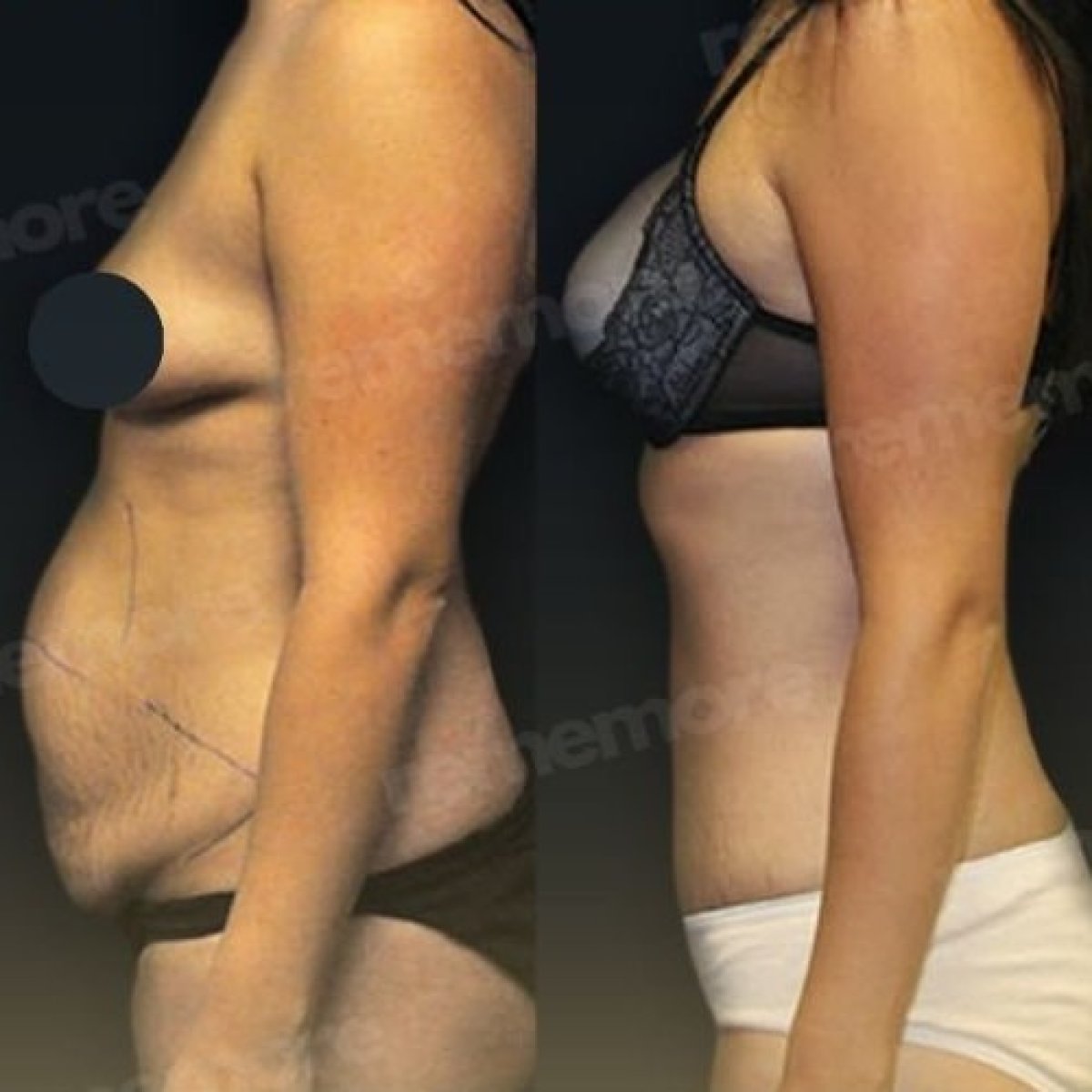 Resultados antes y después de lifting corporal completo en Memorial Göztepe Hospital, mejor contorno