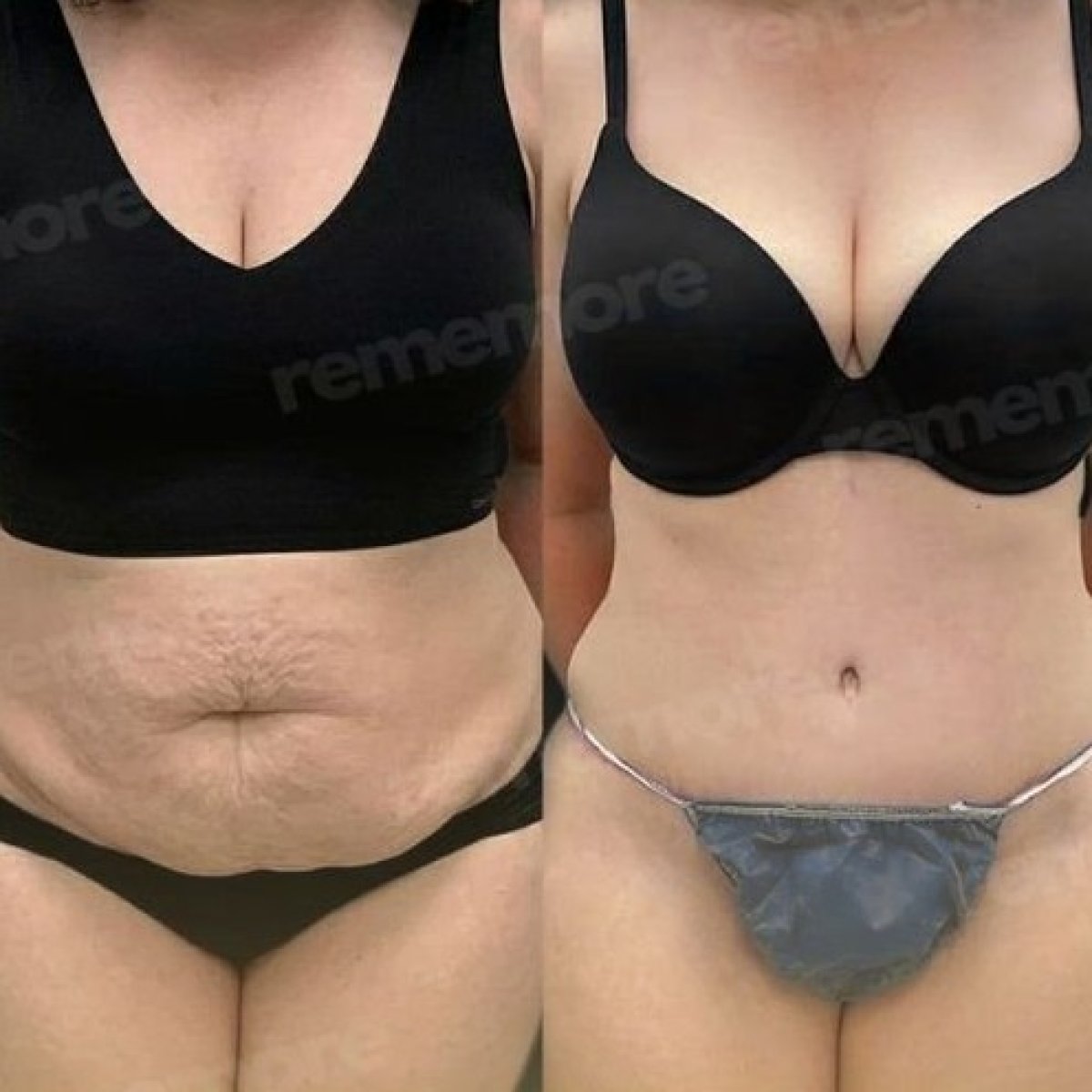 Resultados antes y después de body lift en Memorial Göztepe Hospital, abdomen mejorado