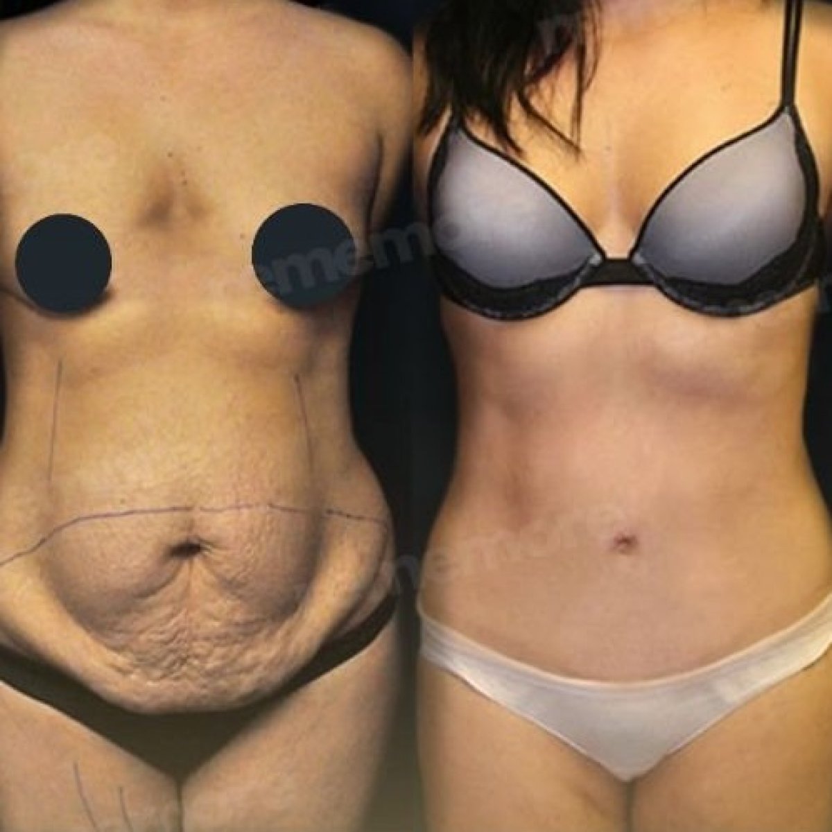 Before and after full body lift results at Memorial Göztepe Hospital, improved body contour