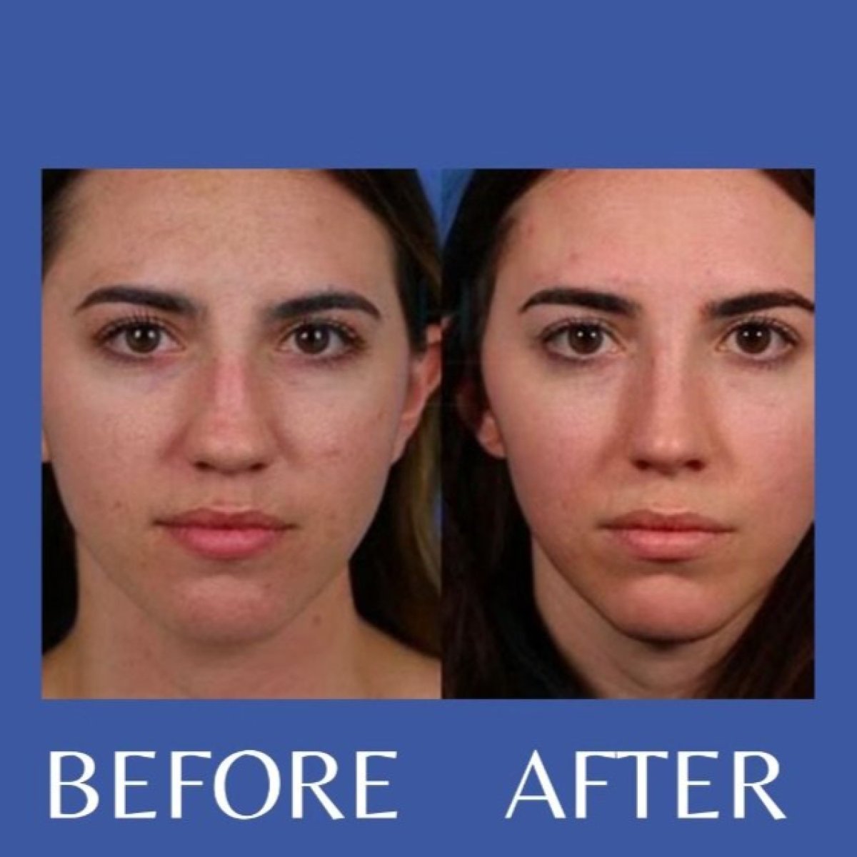 Closed rhinoplasty before and after result at ID Clinic Bangkok, refined nose shape visible