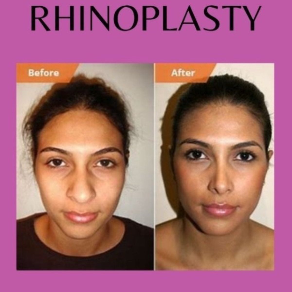 Before and after closed rhinoplasty results at ID Clinic Bangkok, nose reshaping improvement