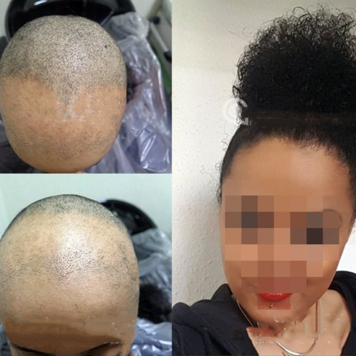 نتائج زراعة الشعر قبل وبعد في CE International Hospital، استعادة خط الشعر لدى سيدة