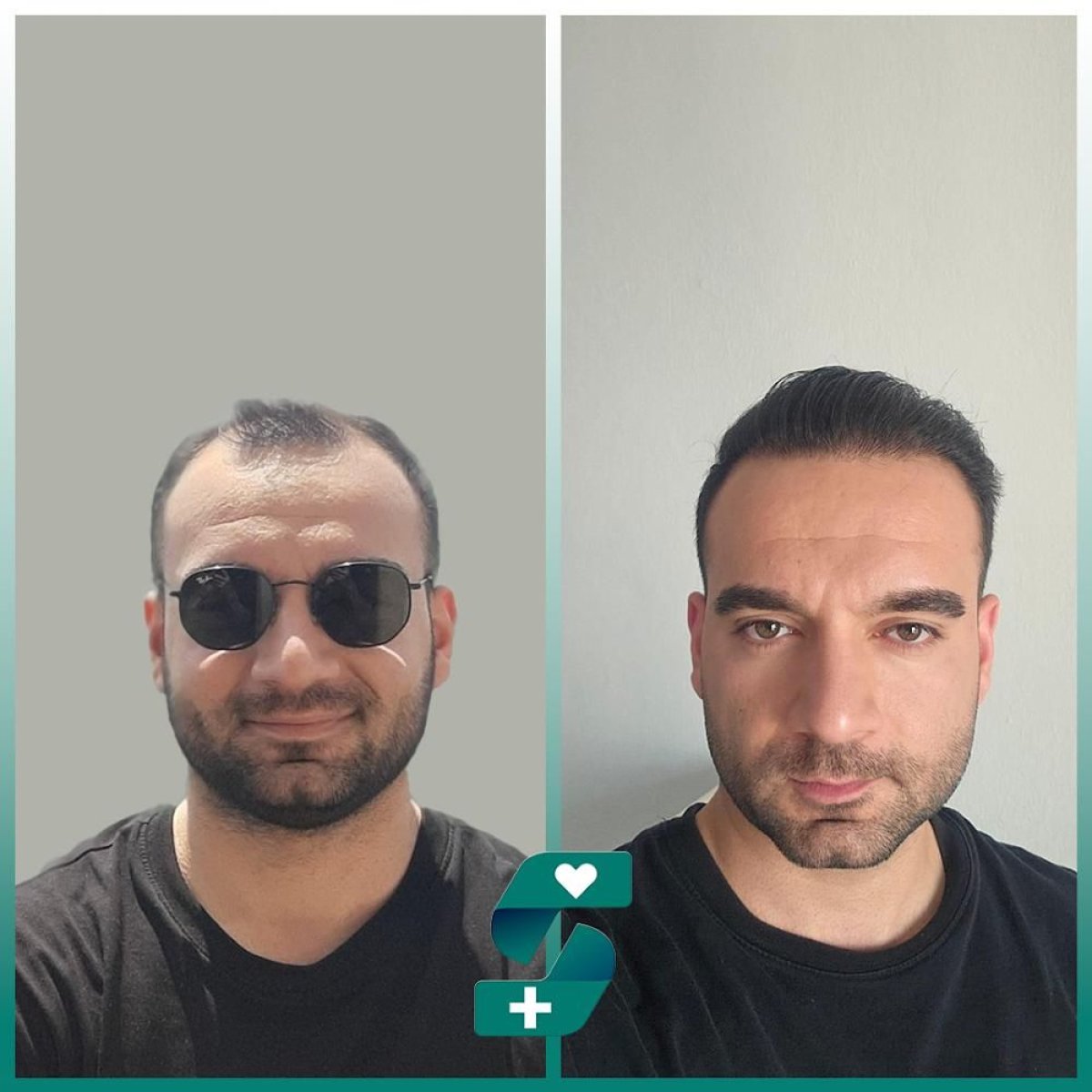 Before and after hair transplant results at Soraca Med – restored hairline and fuller hair