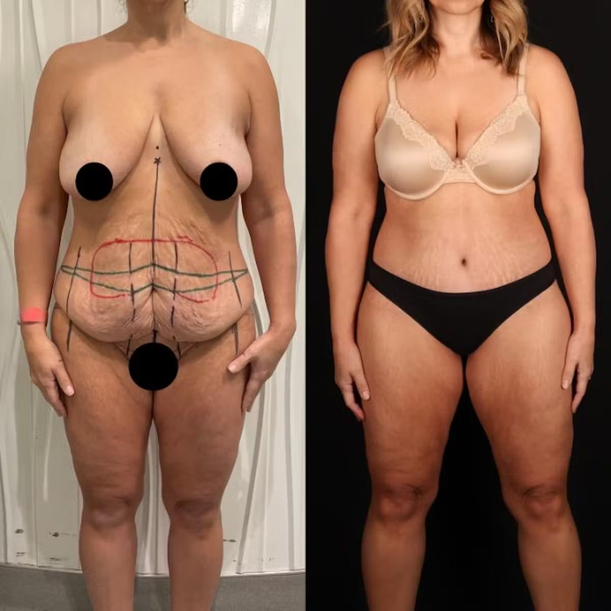 Avant et après liposuccion à DGB Clinic, remodelage corporel et réduction visible de graisse