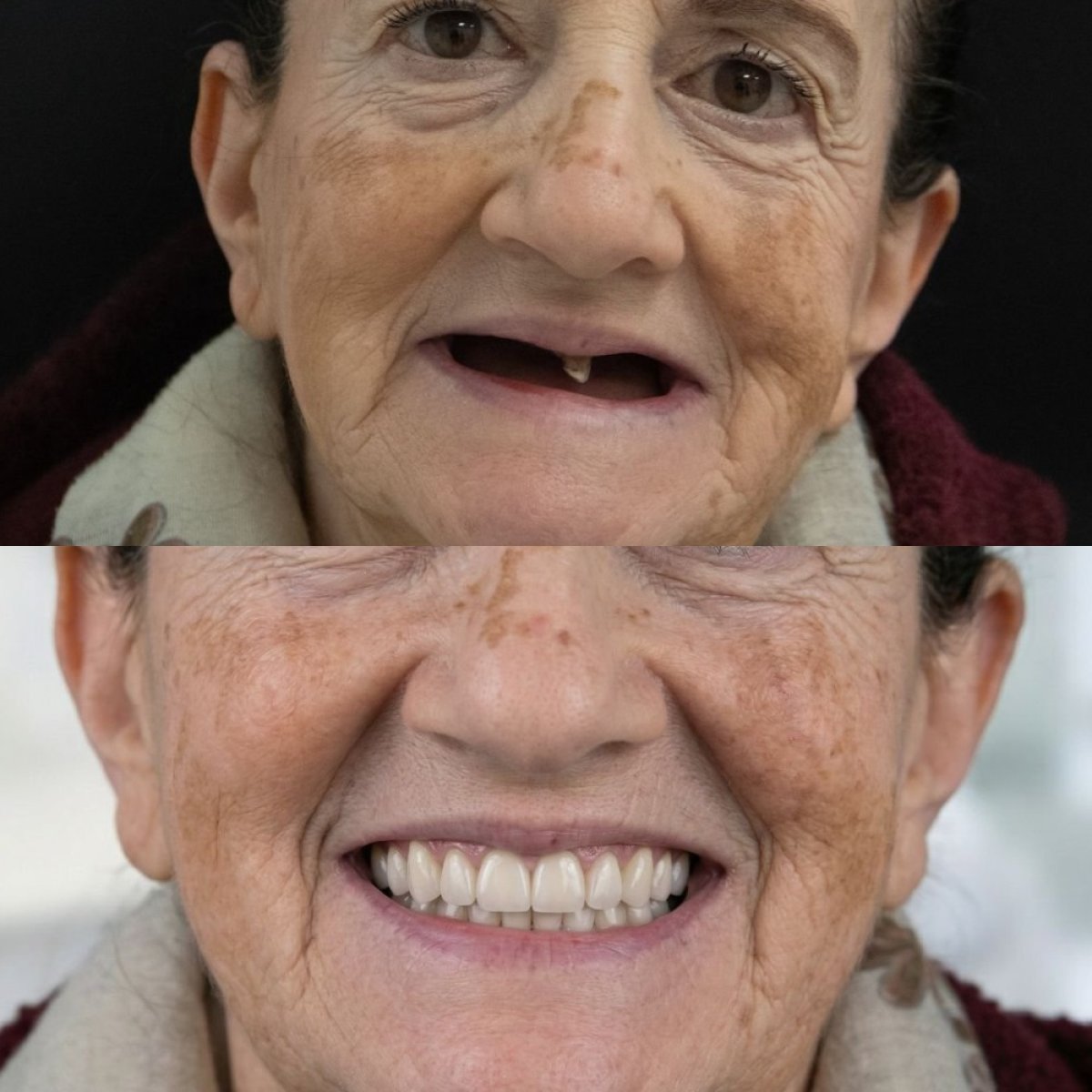 نتيجة قبل وبعد زراعة الأسنان All-on-4 في Excelentis Dental Center، ابتسامة مستعادة