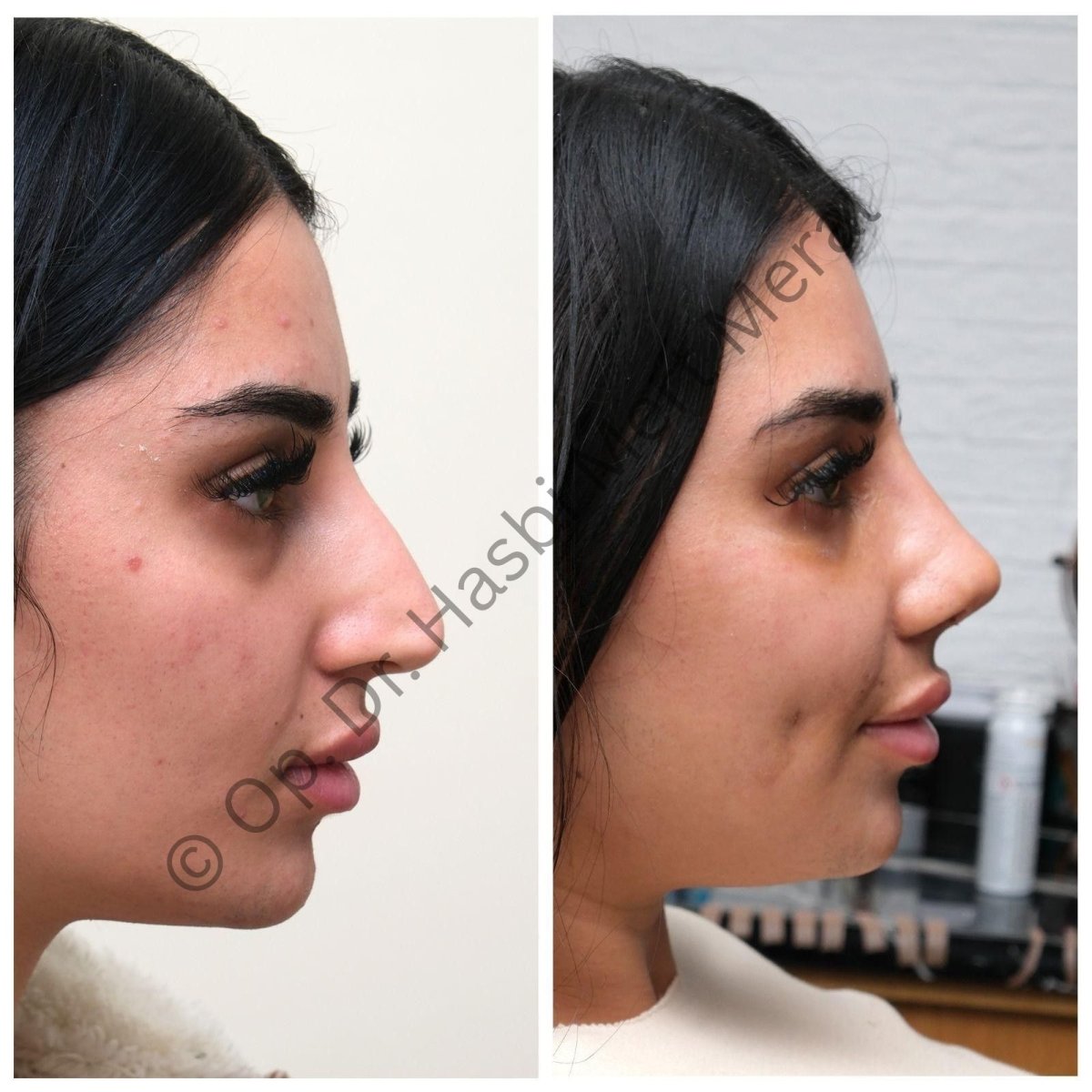 نتائج تجميل الأنف قبل وبعد، إعادة تشكيل الأنف في عيادة د. حسبيني