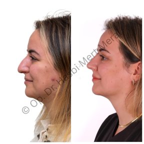 Primary Rhinoplasty (nose job) All Included - photo 6