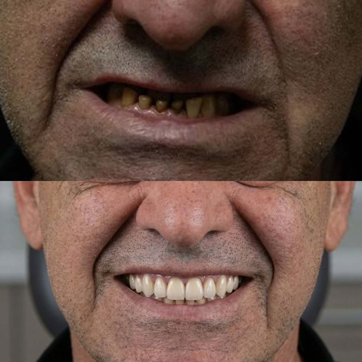 نتيجة قبل وبعد زراعة الأسنان All-on-4 في Excelentis Dental Center، استعادة الابتسامة