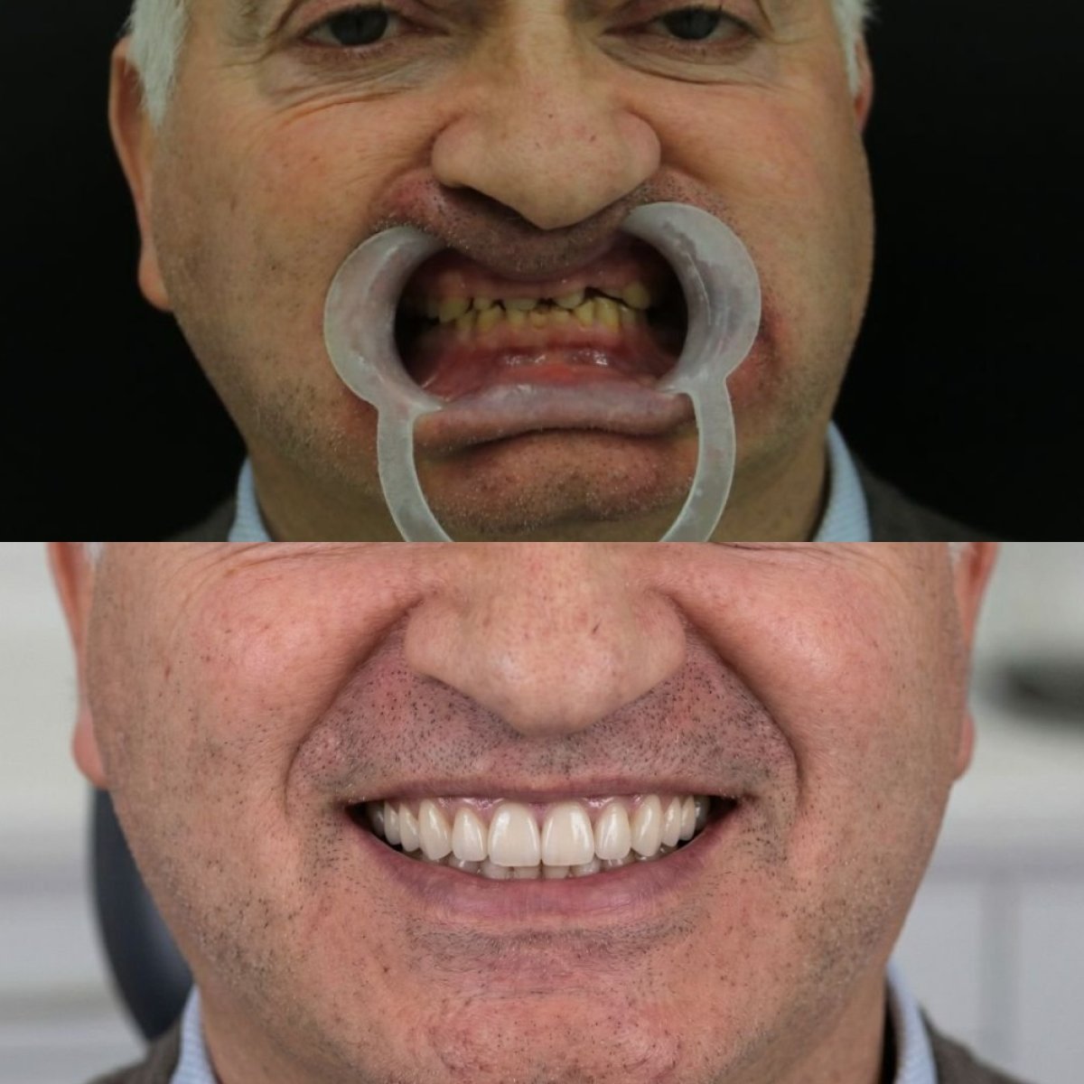 نتائج زراعة الأسنان قبل وبعد في Excelentis Dental Center، ابتسامة طبيعية مستعادة
