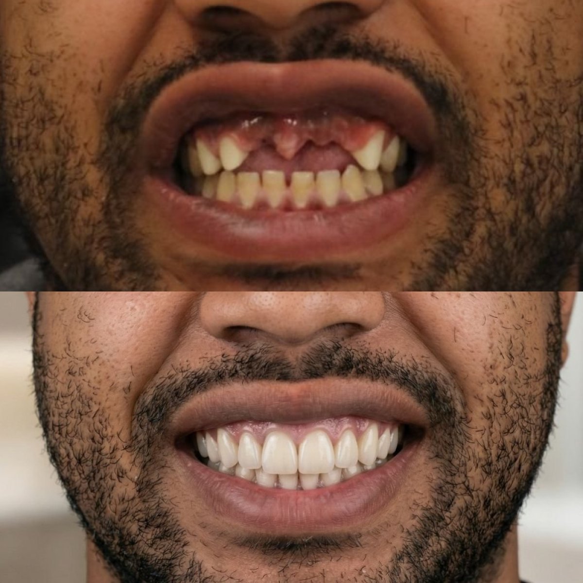 Результаты до и после имплантации зубов в Excelentis Dental Center – восстановленная улыбка